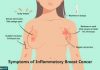 ਬ੍ਰੈਸਟ ਕੈਂਸਰ ਦੇ ਲੱਛਣ ਅਤੇ ਸੰਕੇਤ
